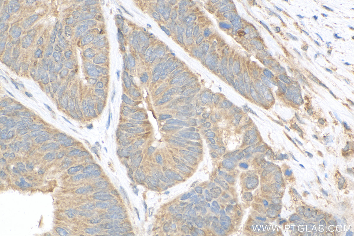 IHC staining of human colon cancer using 26001-1-AP