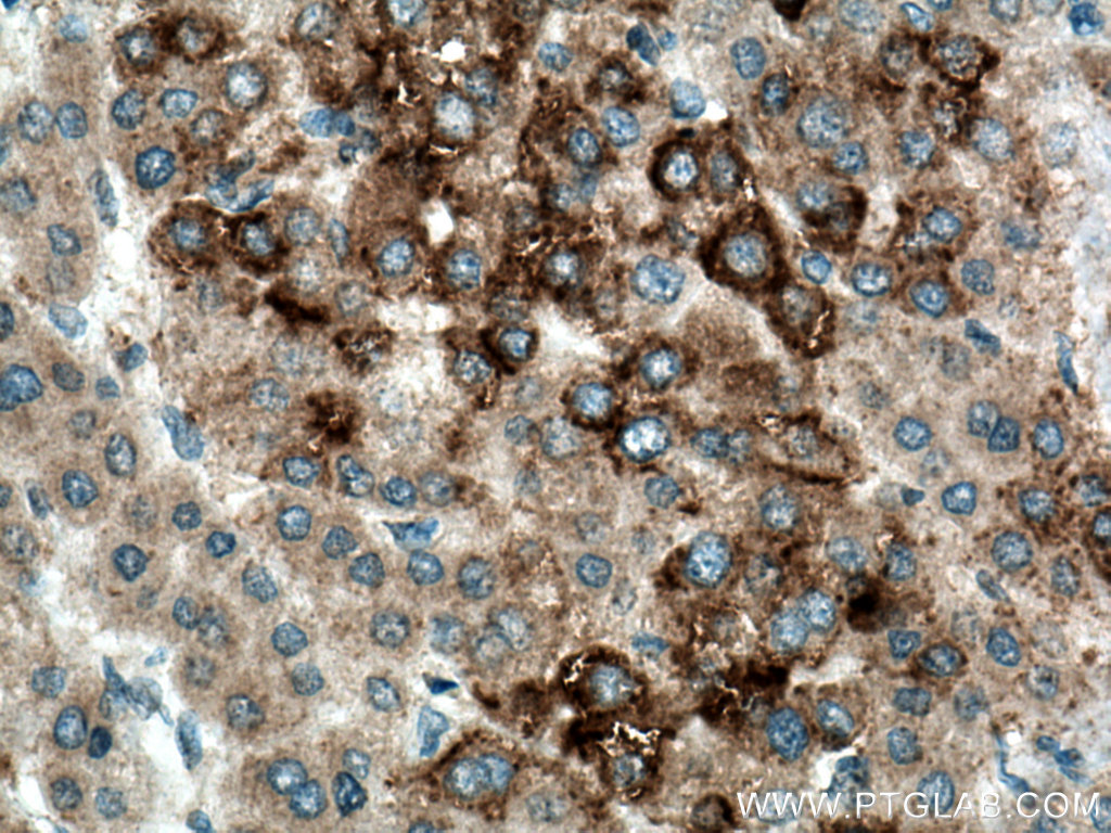 IHC staining of human liver cancer using 13252-1-AP