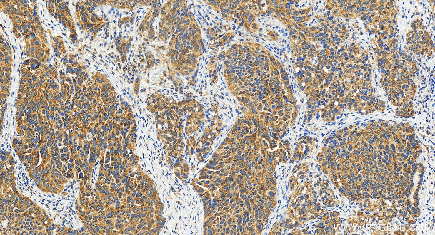 IHC staining of human ovary cancer using 29624-1-AP