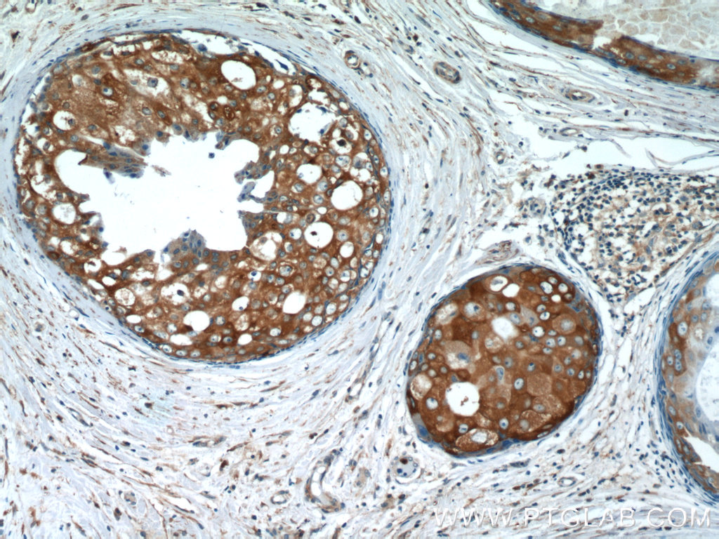 IHC staining of human breast cancer using 17976-1-AP