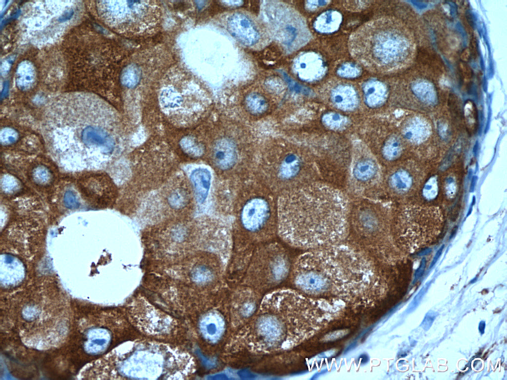 IHC staining of human breast cancer using 17976-1-AP