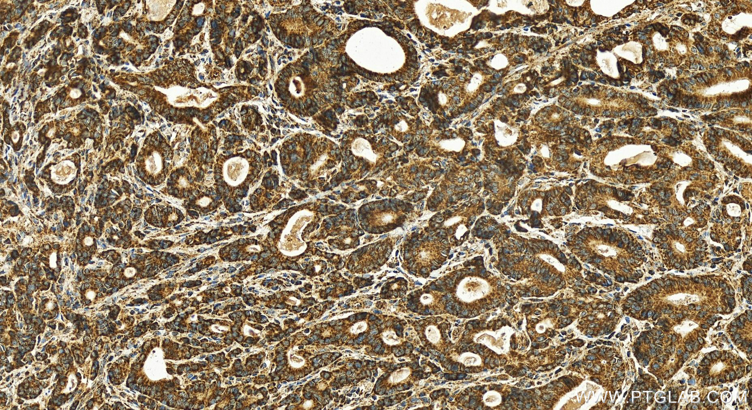 IHC staining of human stomach cancer using 12212-1-AP