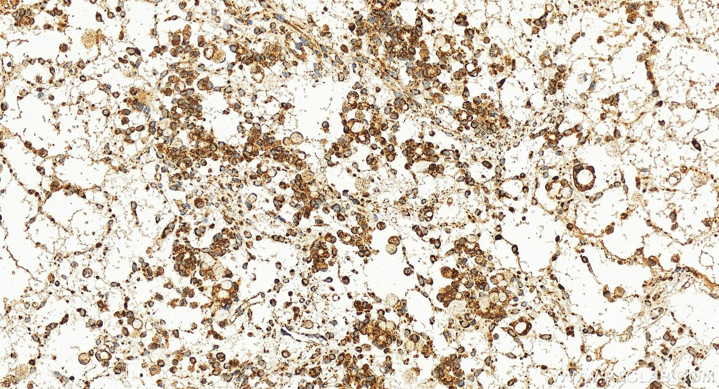 IHC staining of human ovary cancer using 12212-1-AP