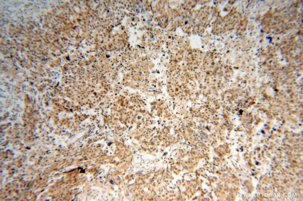 IHC staining of human ovary tumor using 15696-1-AP