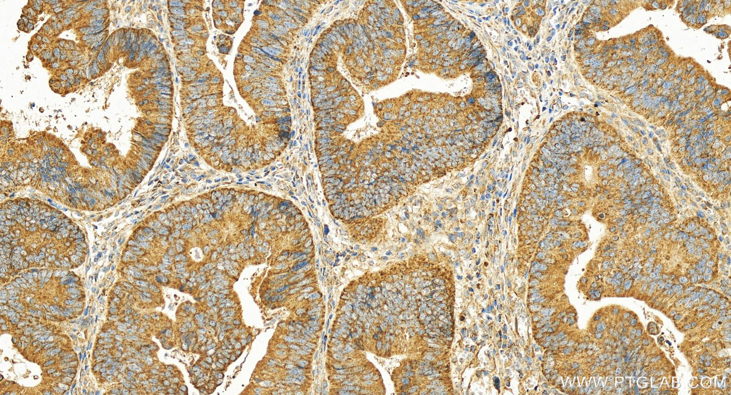 IHC staining of human colon cancer using 14355-1-AP