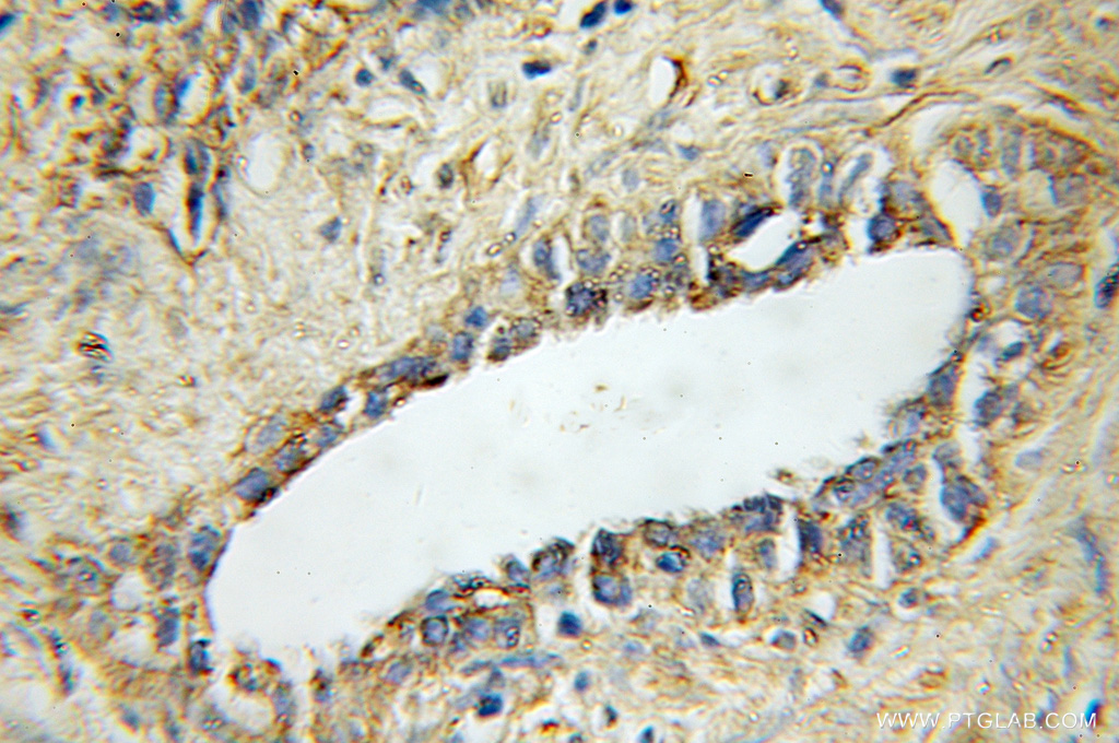 IHC staining of human prostate cancer using 11346-1-AP