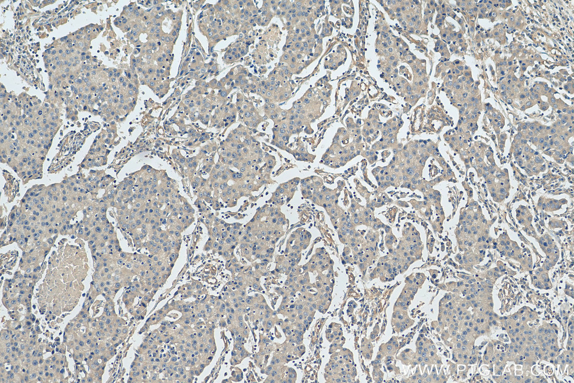 IHC staining of human breast cancer using 20502-1-AP