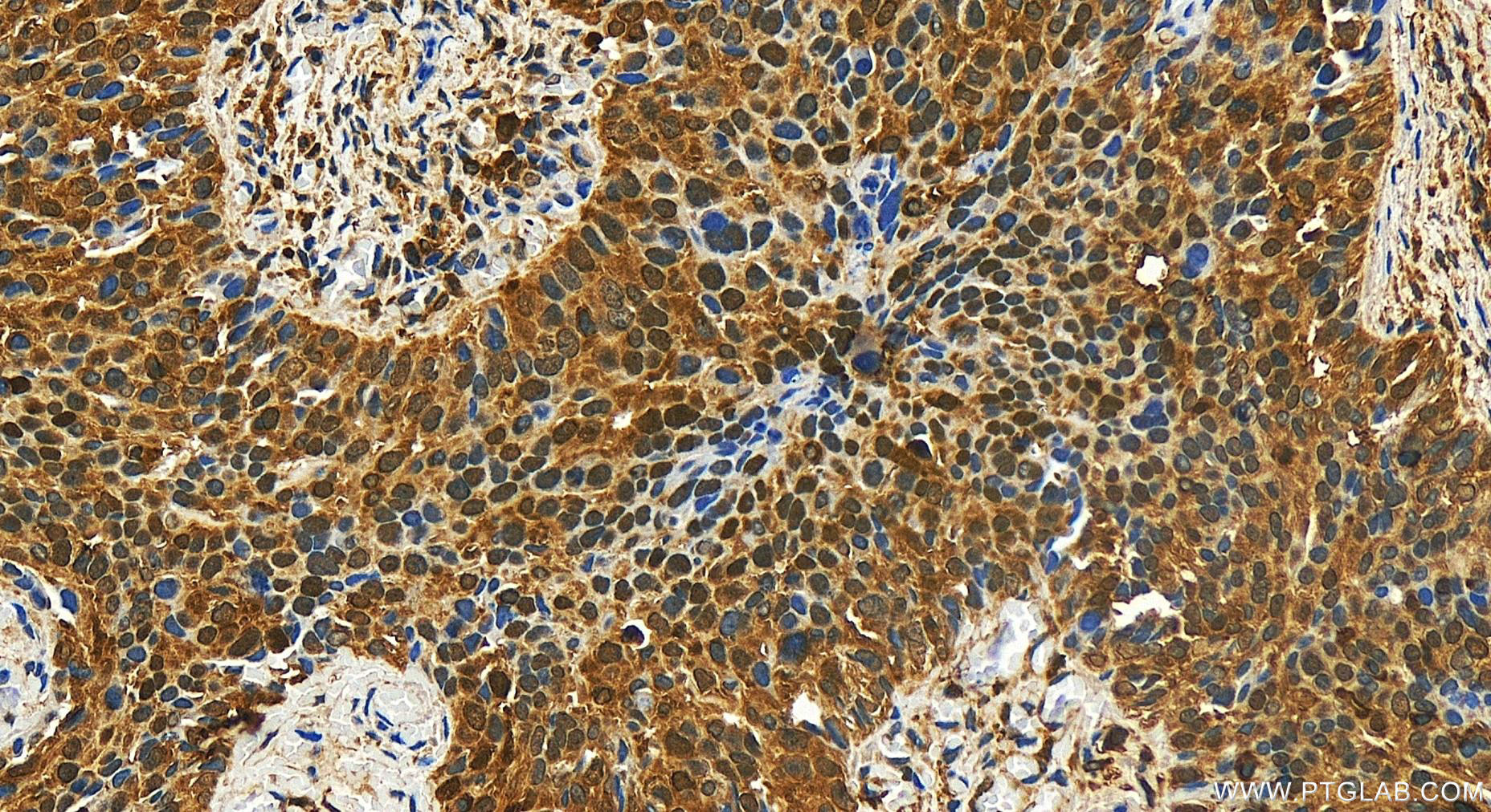 IHC staining of human ovary cancer using 10144-2-AP