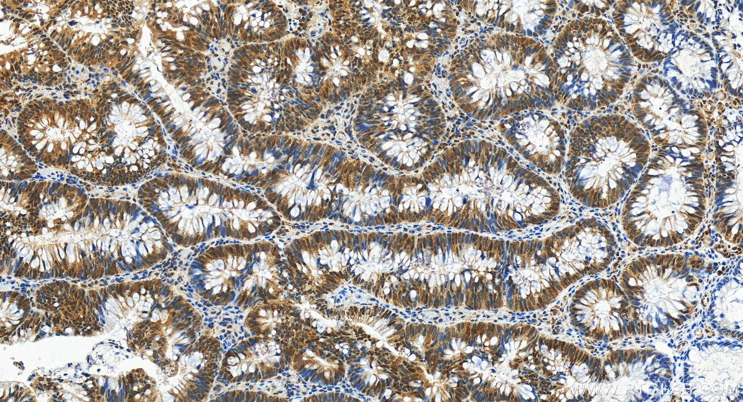 IHC staining of human colon cancer using 82630-1-RR