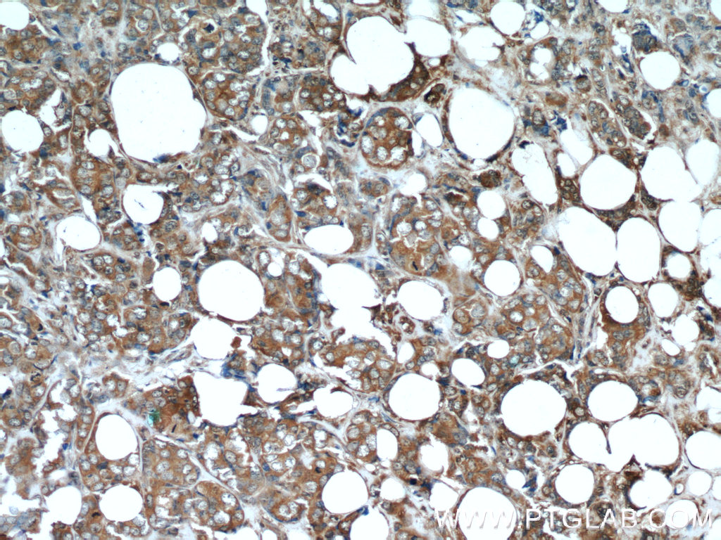 IHC staining of human breast cancer using 60063-1-Ig (same clone as 60063-1-PBS)