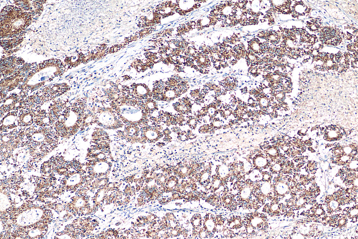 IHC staining of human colon cancer using 24804-1-AP (same clone as 24804-1-PBS)