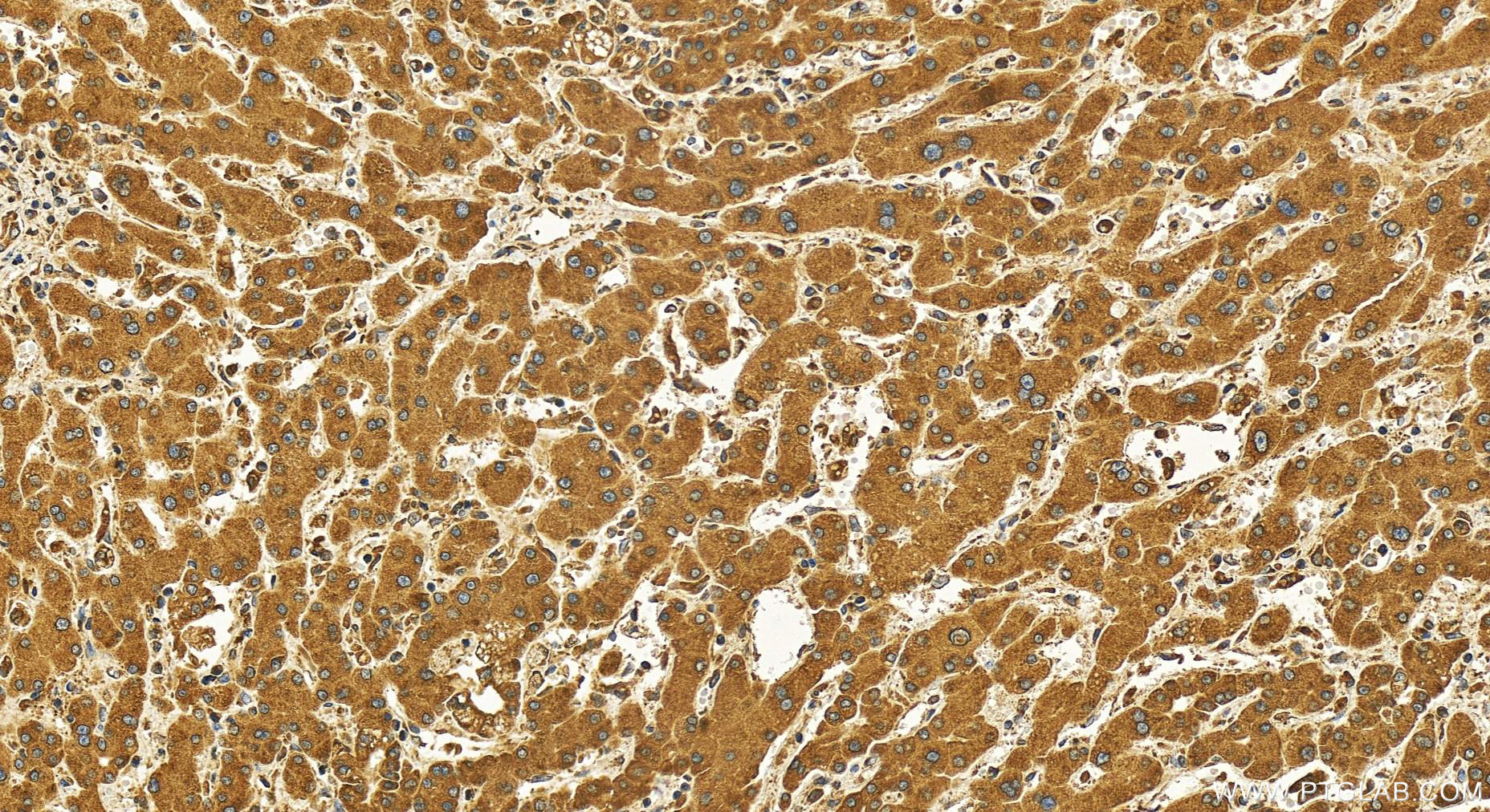 IHC staining of human intrahepatic cholangiocarcinoma using 81156-1-RR (same clone as 81156-1-PBS)