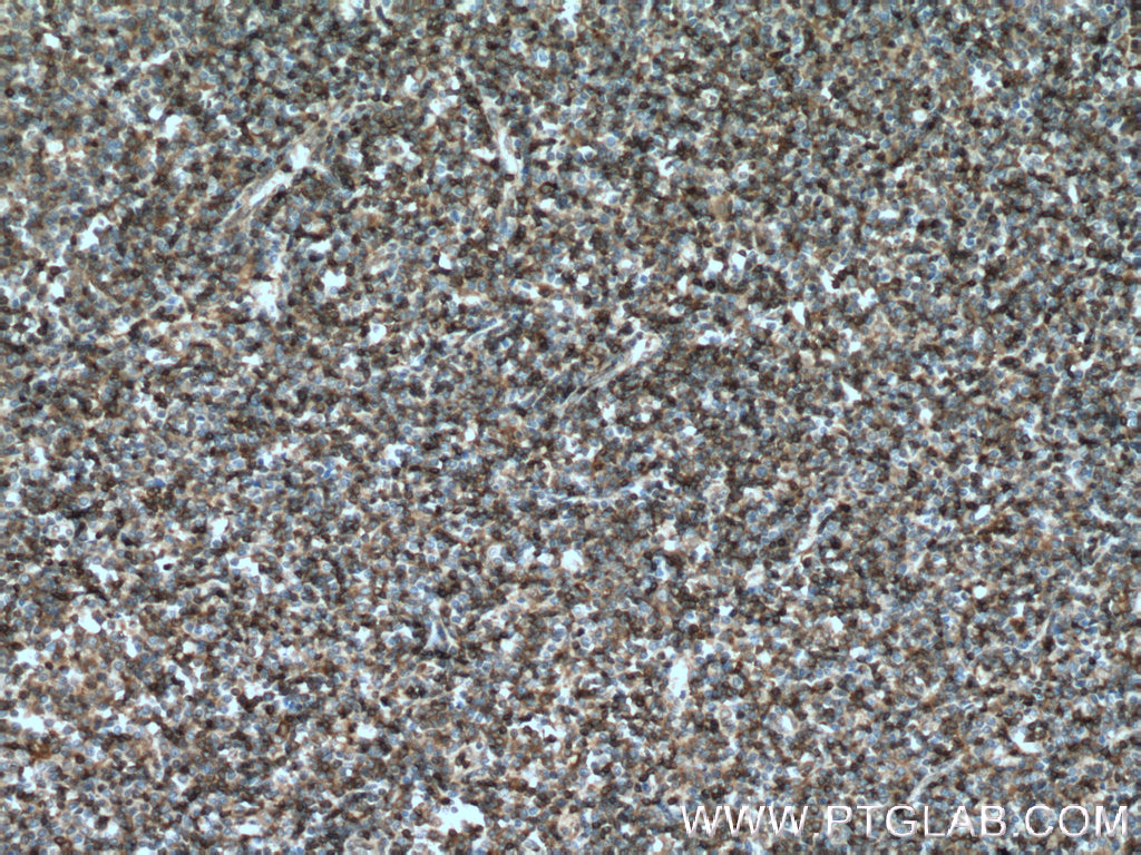 IHC staining of human lymphoma using 25471-1-AP