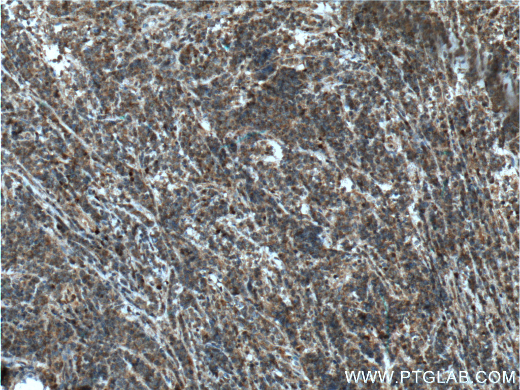 IHC staining of human lymphoma using 26600-1-AP