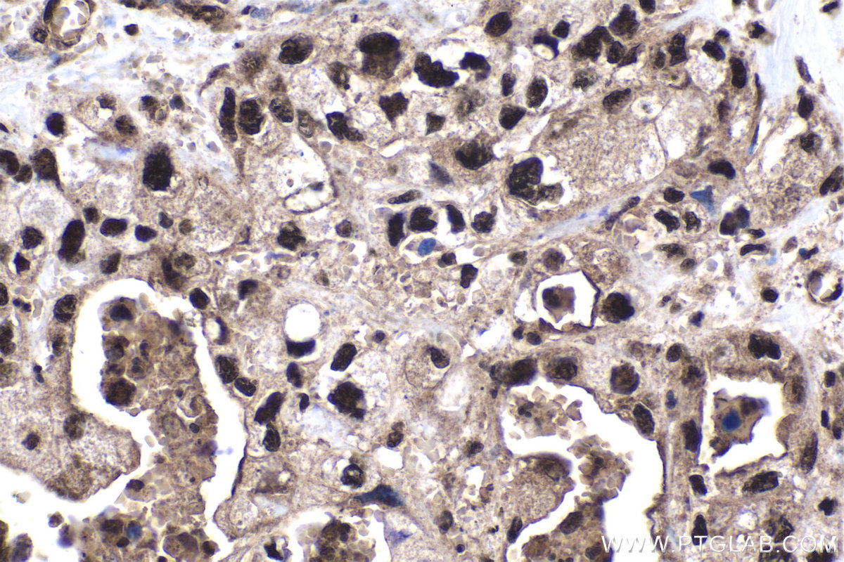 IHC staining of human pancreas cancer using 12097-1-AP