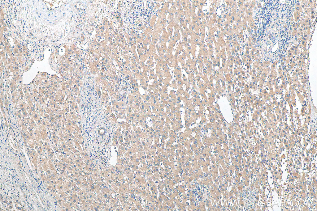 IHC staining of human liver cancer using 12857-1-AP