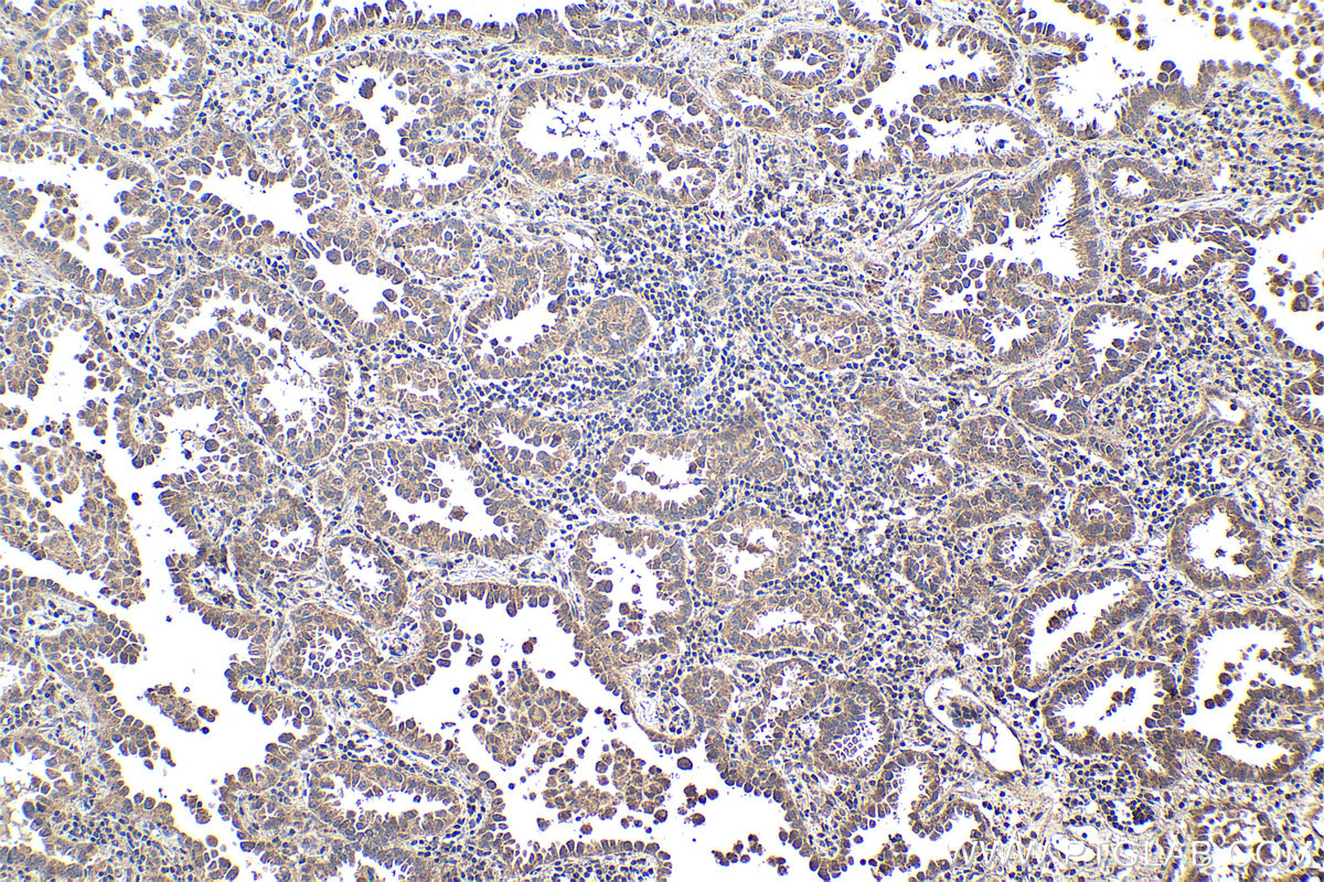 IHC staining of human lung cancer using 12559-1-AP