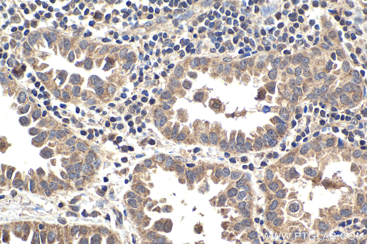 IHC staining of human lung cancer using 12559-1-AP