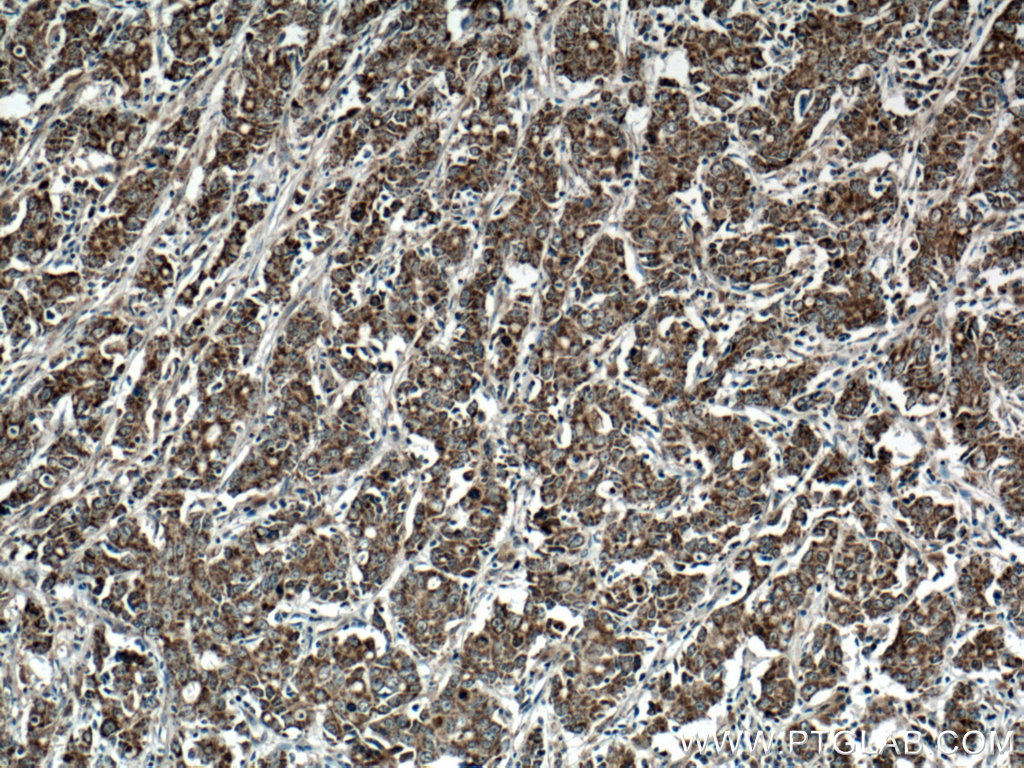 IHC staining of human stomach cancer using 10348-1-AP