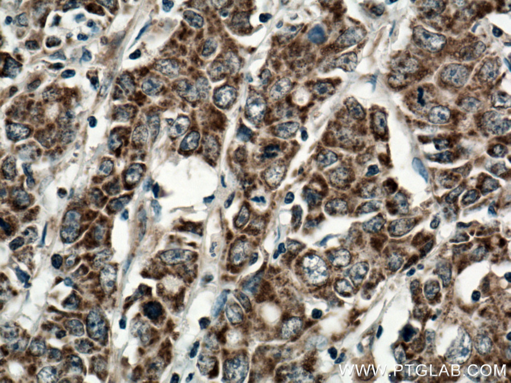 IHC staining of human stomach cancer using 10348-1-AP