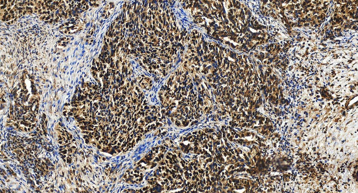 IHC staining of human ovary cancer using 17362-1-AP