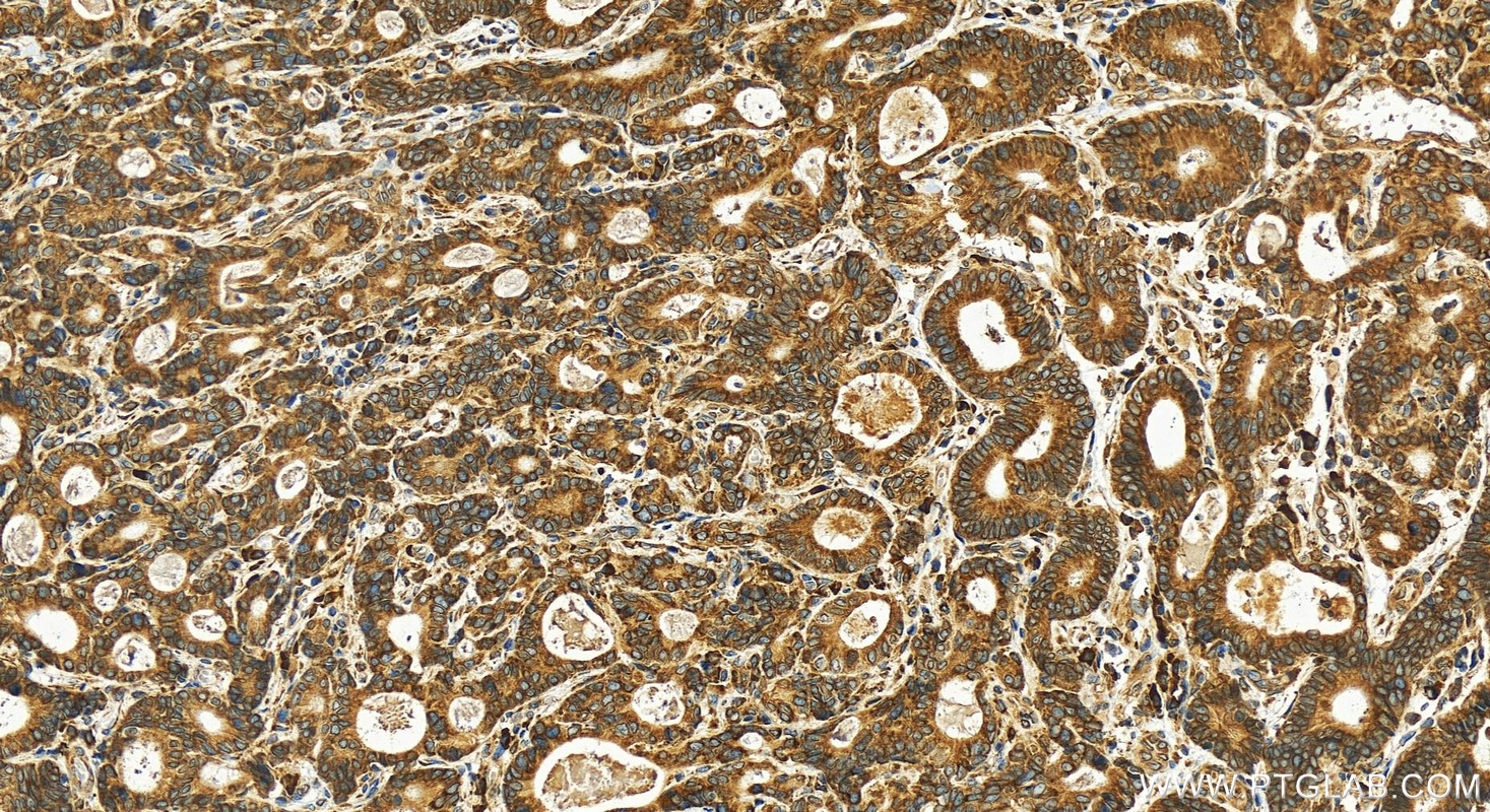 IHC staining of human stomach cancer using 12034-1-AP