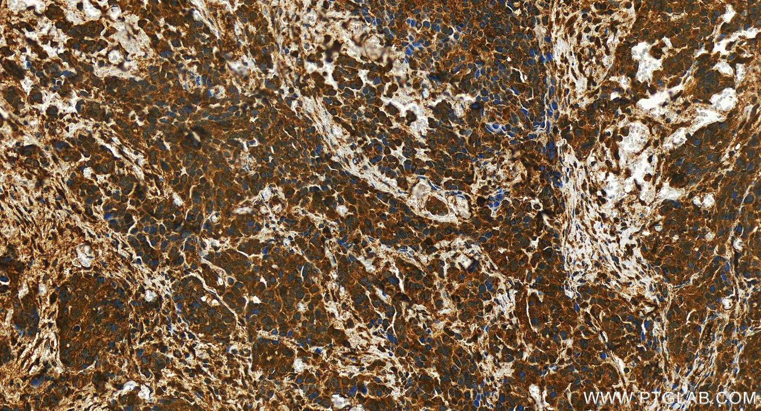 IHC staining of human ovary cancer using 10911-2-AP