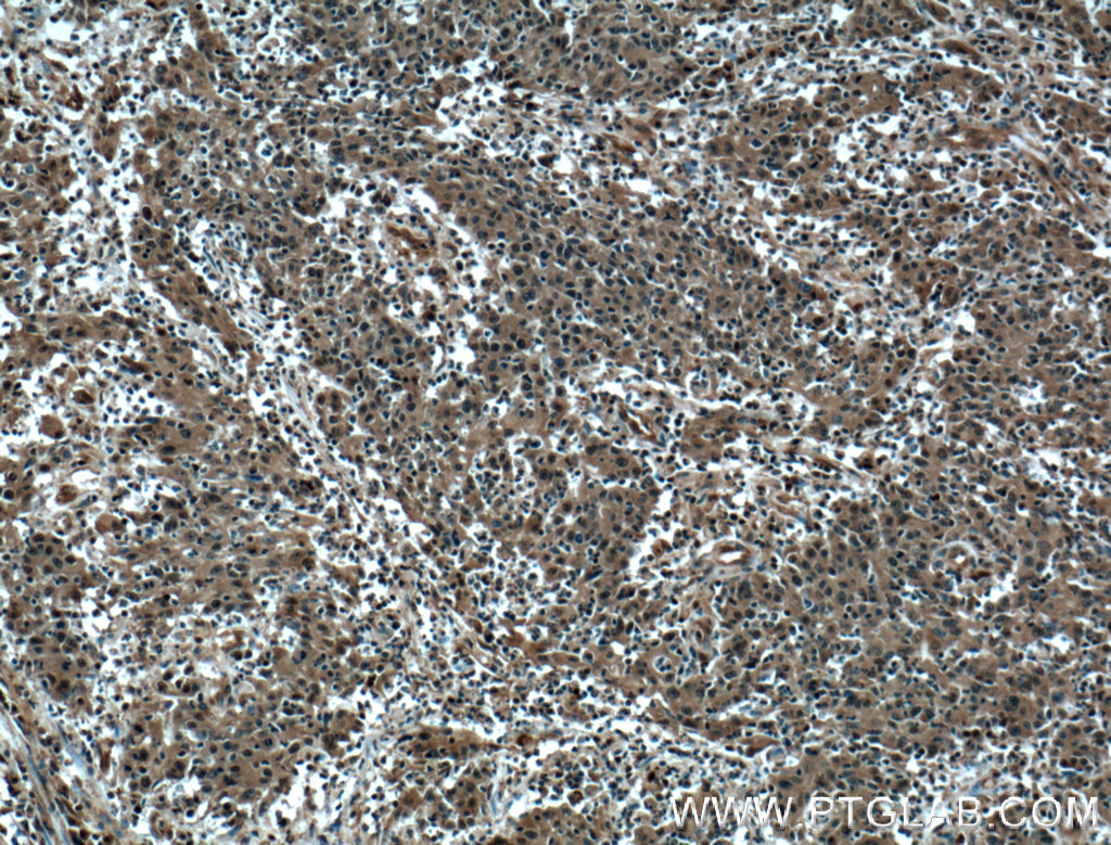 IHC staining of human colon cancer using 10947-1-AP