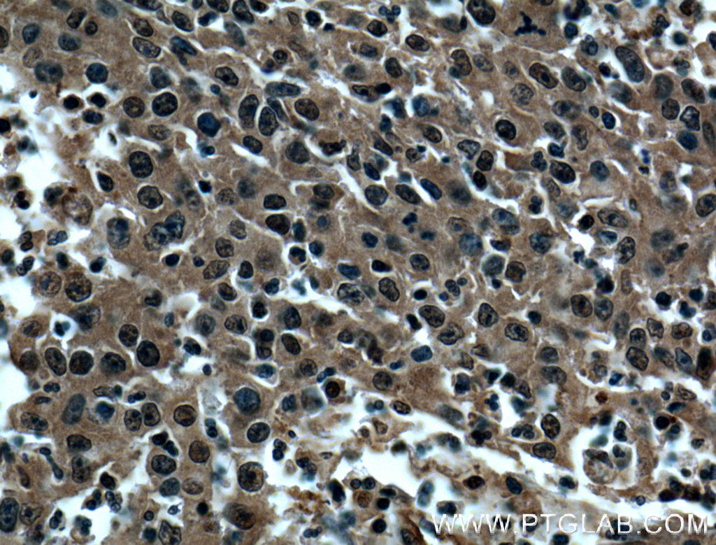 IHC staining of human colon cancer using 10947-1-AP