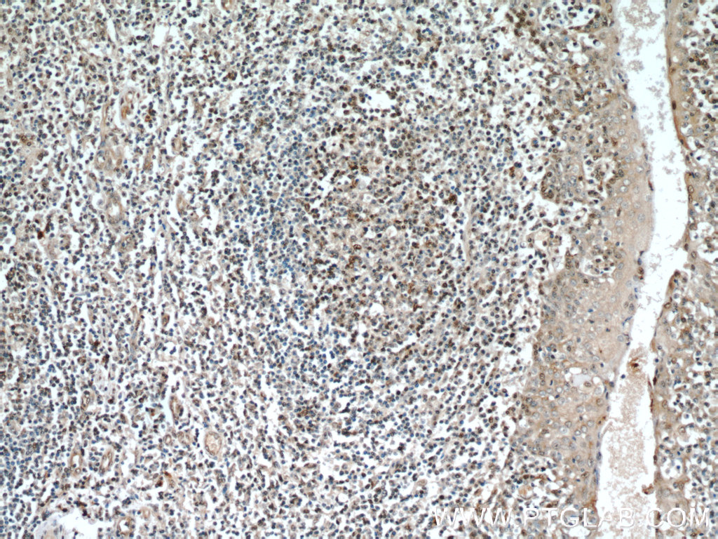 IHC staining of human tonsillitis using 20551-1-AP