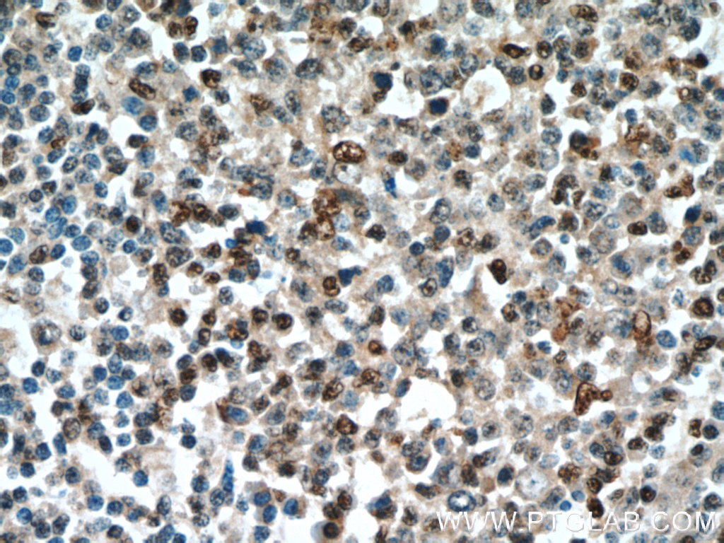 IHC staining of human tonsillitis using 20551-1-AP