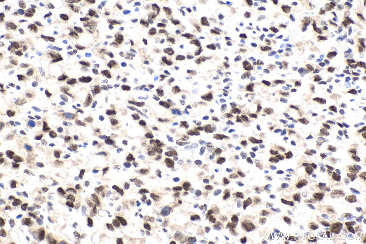 IHC staining of human stomach cancer using 23073-1-AP