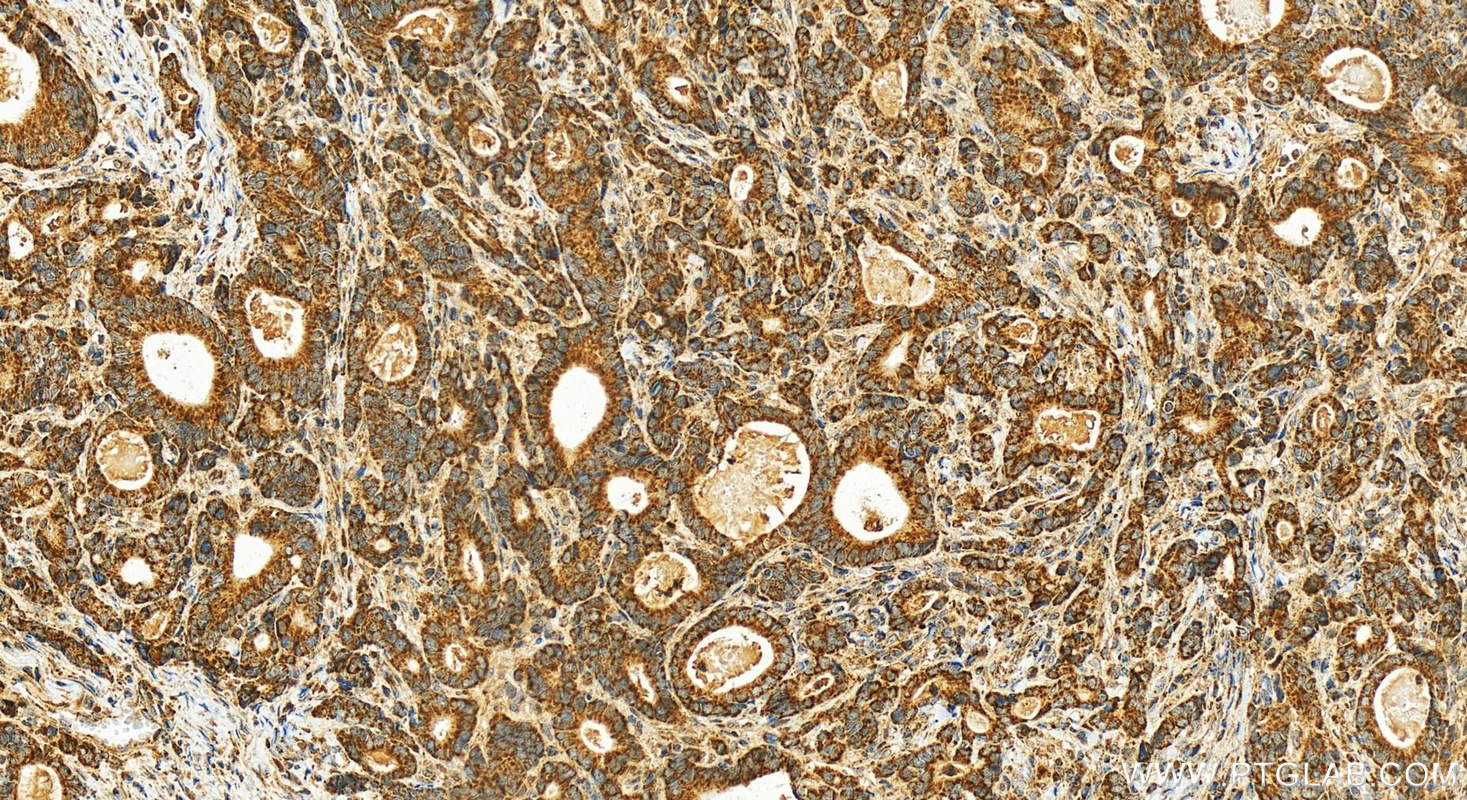 IHC staining of human stomach cancer using 12826-1-AP