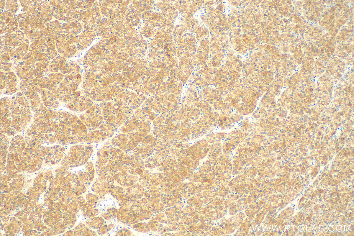 IHC staining of human liver cancer using 83052-5-RR (same clone as 83052-5-PBS)