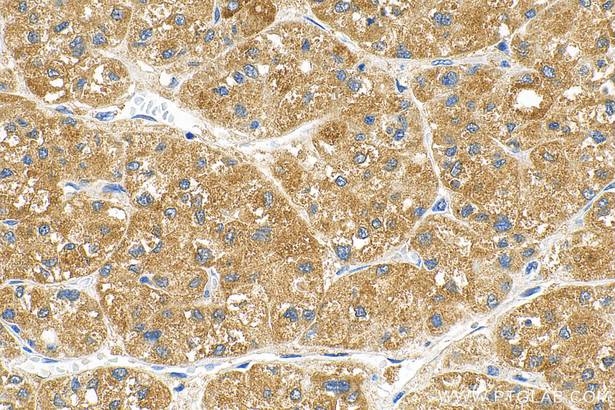 IHC staining of human liver cancer using 83052-5-RR (same clone as 83052-5-PBS)