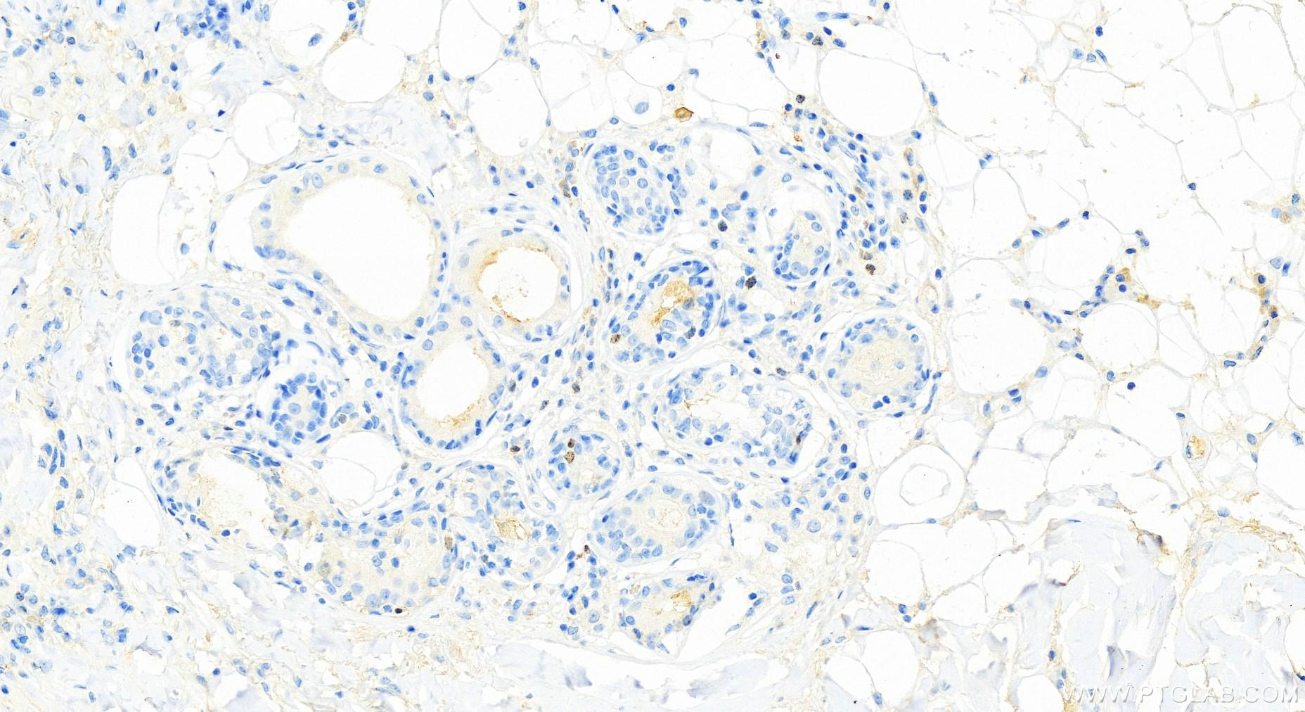 IHC staining of human skin cancer using 66495-1-Ig