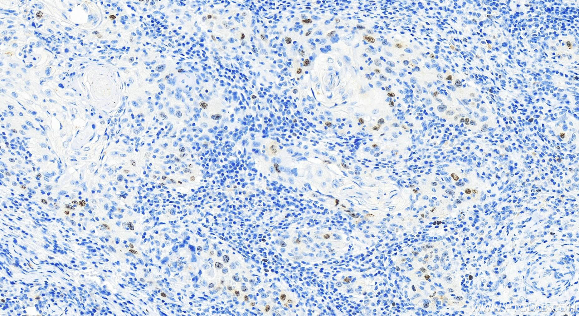 IHC staining of human skin cancer using 66495-1-Ig (same clone as 66495-1-PBS)