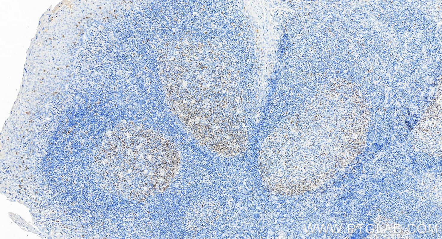 IHC staining of human tonsillitis using 66495-1-Ig (same clone as 66495-1-PBS)