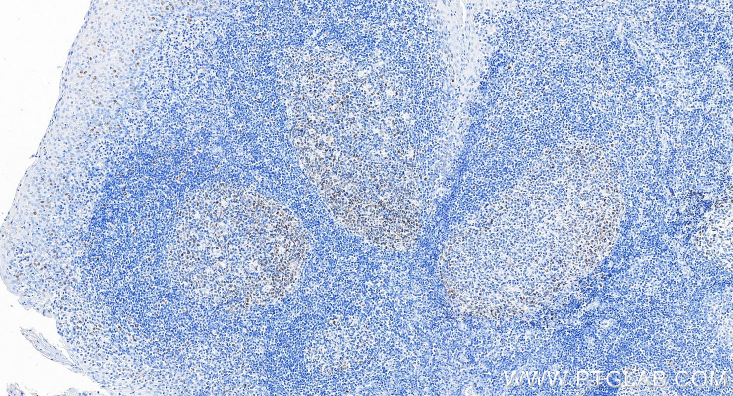 IHC staining of human tonsillitis using 66495-1-Ig (same clone as 66495-1-PBS)