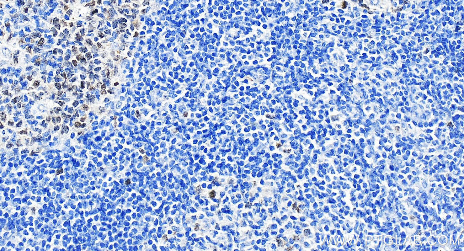 IHC staining of human tonsillitis using 66495-1-Ig