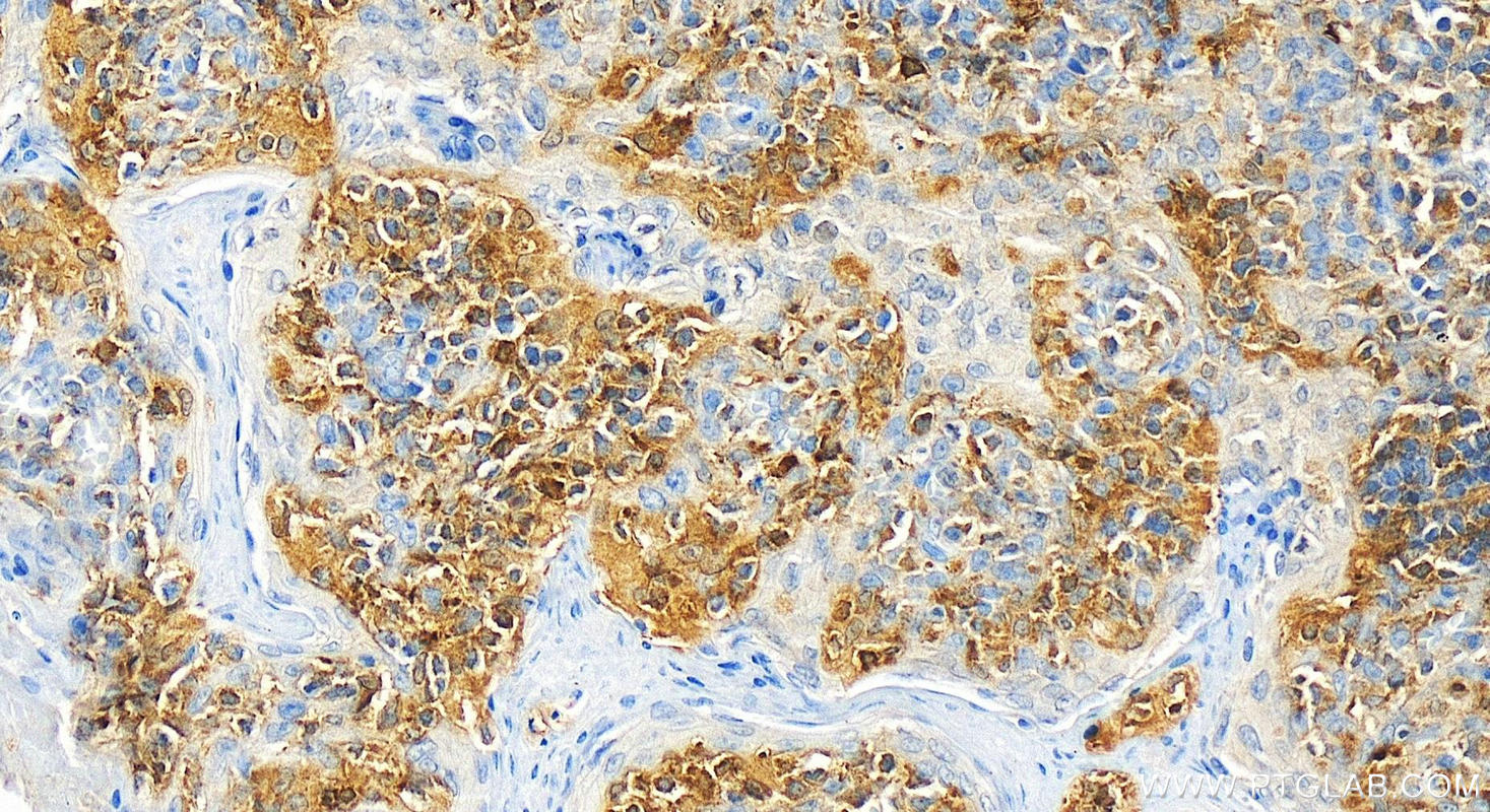 IHC staining of human tonsillitis using 66721-1-Ig