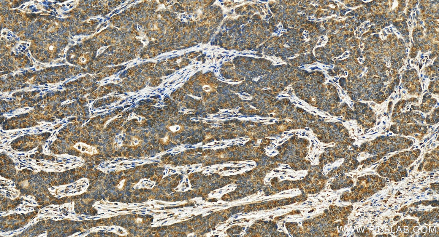 IHC staining of human stomach cancer using 18115-1-AP