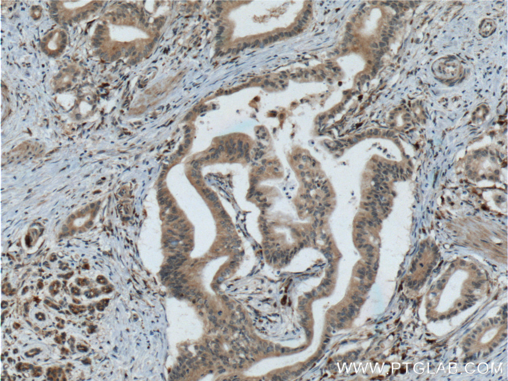 IHC staining of human pancreas cancer using 60086-1-Ig