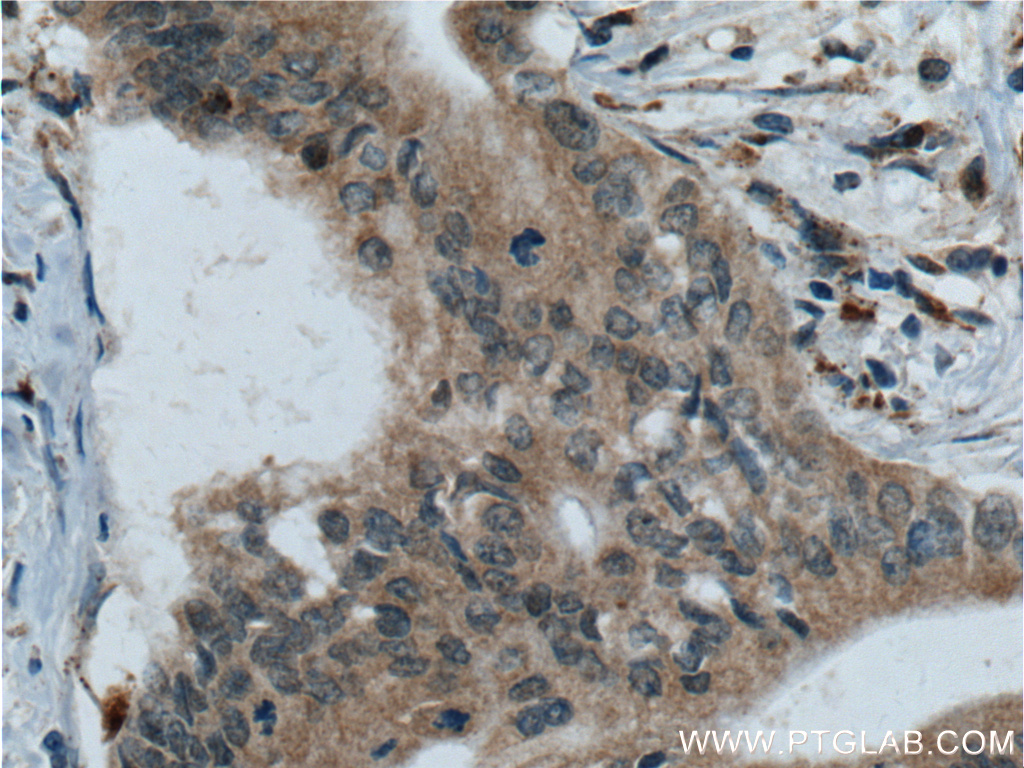 IHC staining of human pancreas cancer using 60086-1-Ig