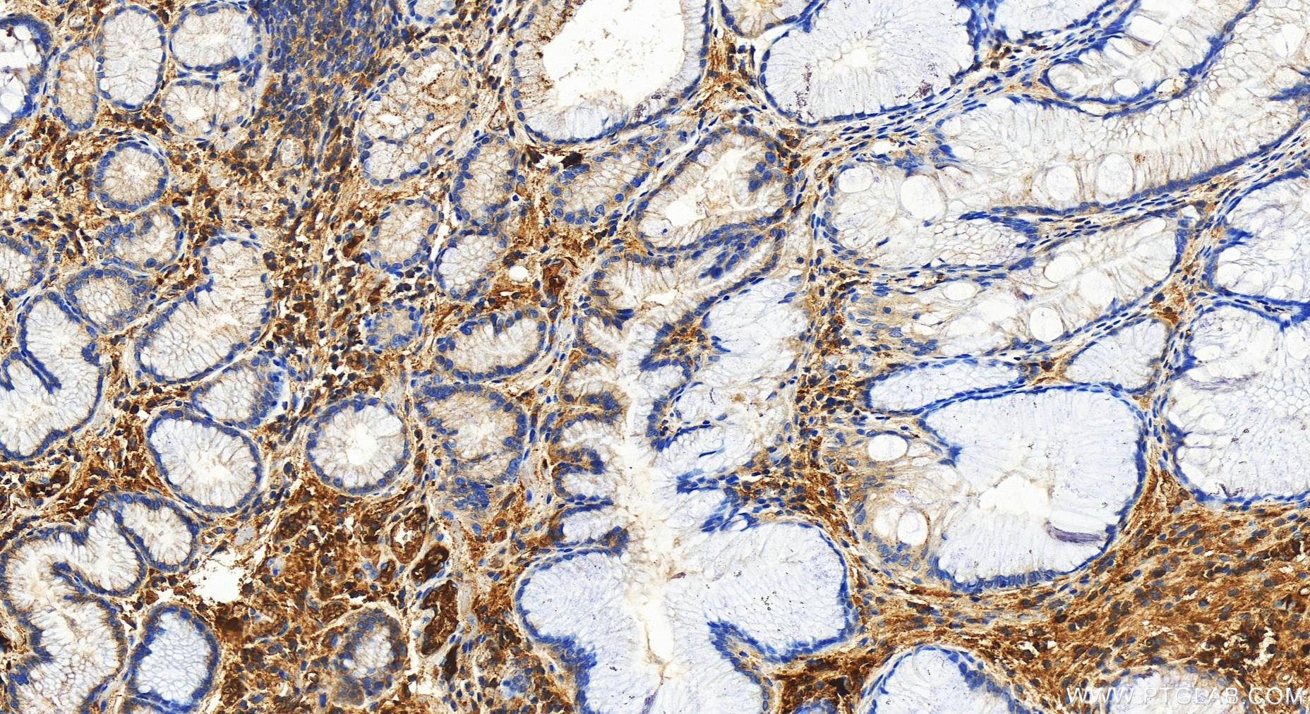 IHC staining of human stomach cancer using 31813-1-AP