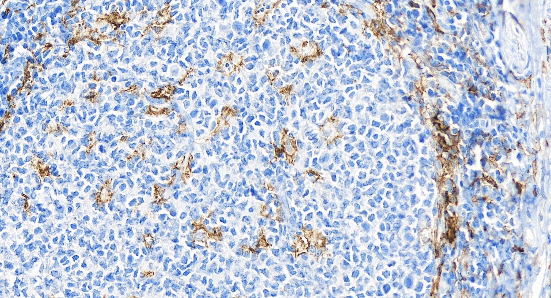 IHC staining of human tonsillitis using 84253-4-RR