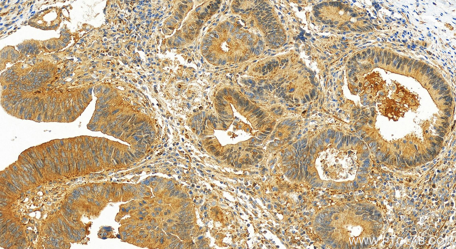 IHC staining of human colon cancer using 27566-1-AP