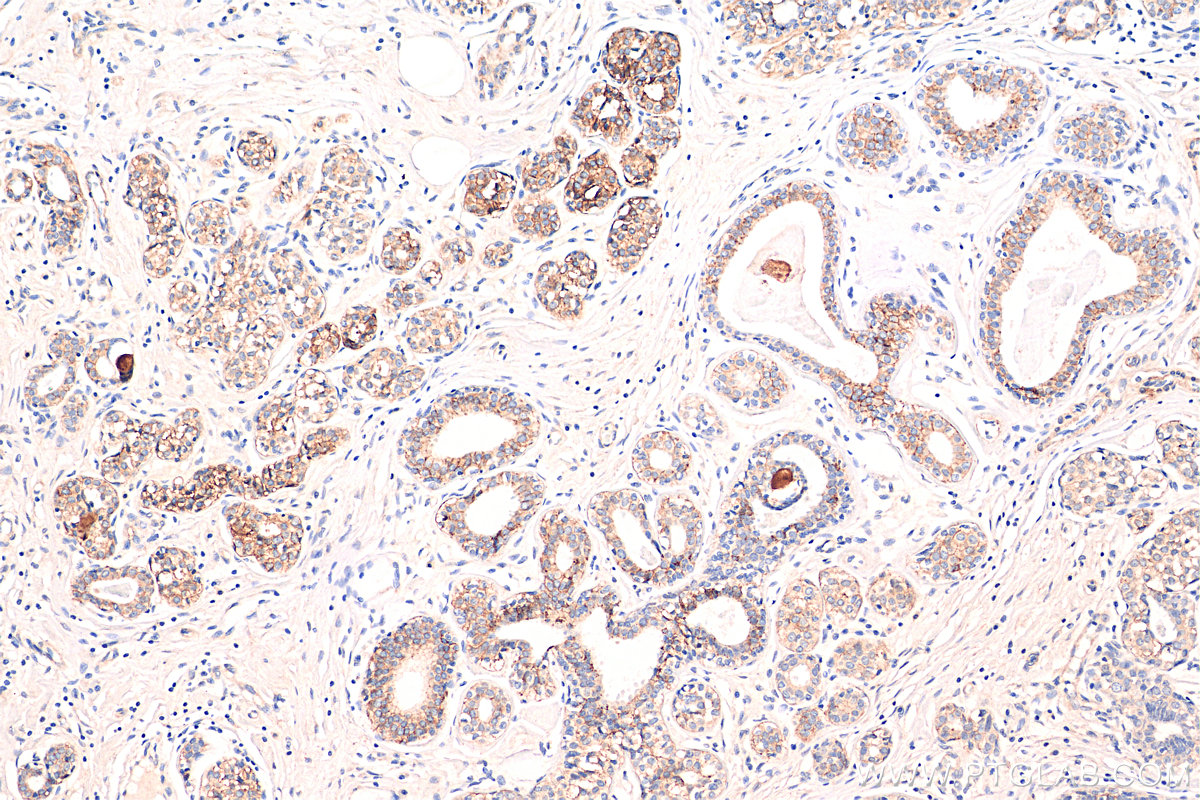 IHC staining of human breast cancer using 68141-1-Ig (same clone as 68141-1-PBS)