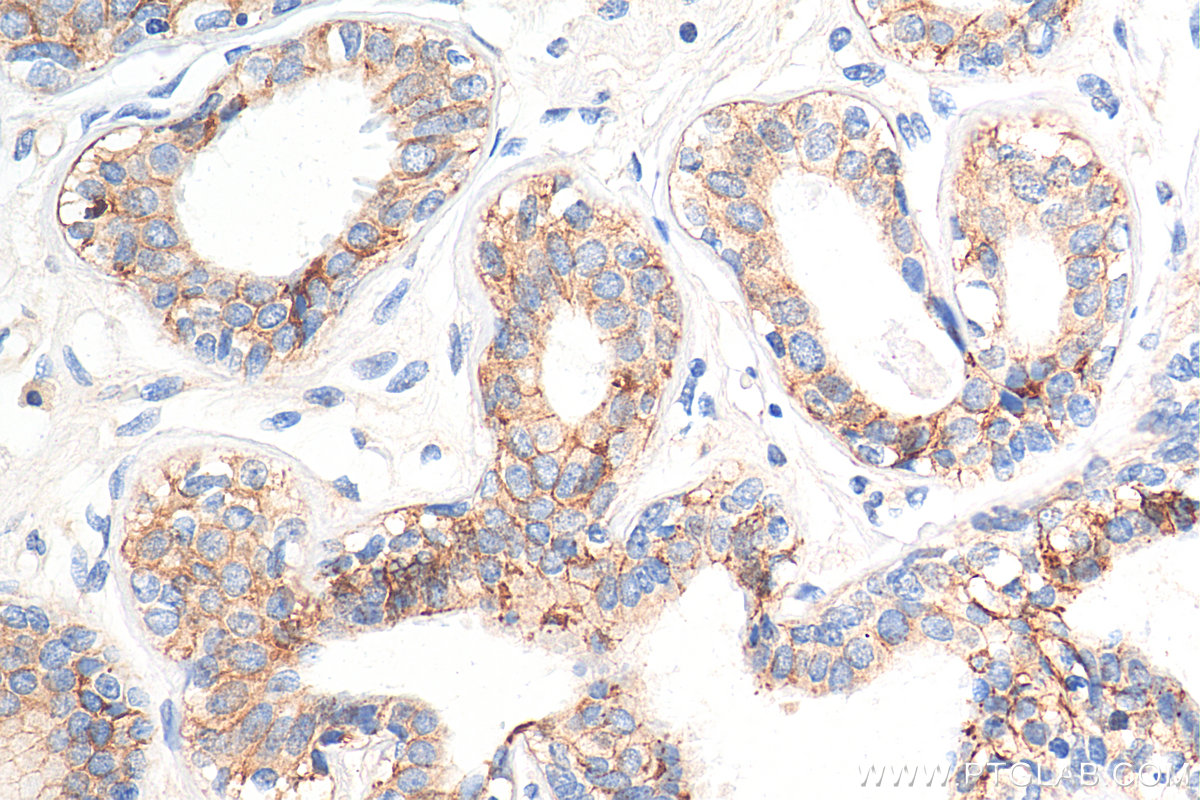 IHC staining of human breast cancer using 68141-1-Ig (same clone as 68141-1-PBS)