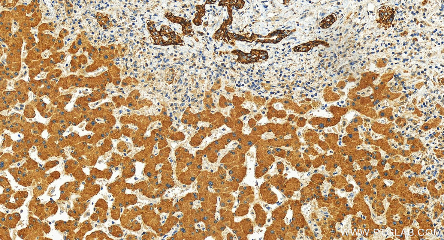 IHC staining of human intrahepatic cholangiocarcinoma using 29856-1-AP